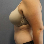 Abdominoplasty Before & After Patient #5197