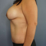 Abdominoplasty Before & After Patient #3735
