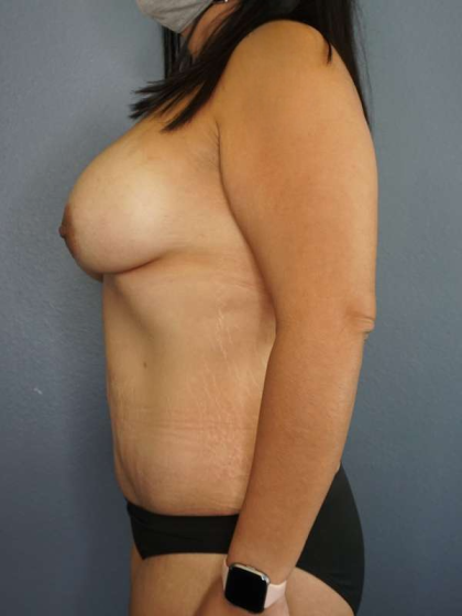 Abdominoplasty Before & After Patient #3735