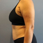 Abdominoplasty Before & After Patient #3583