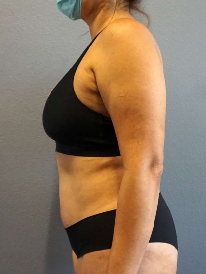 Abdominoplasty Before & After Patient #3583