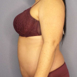 Abdominoplasty Before & After Patient #3572