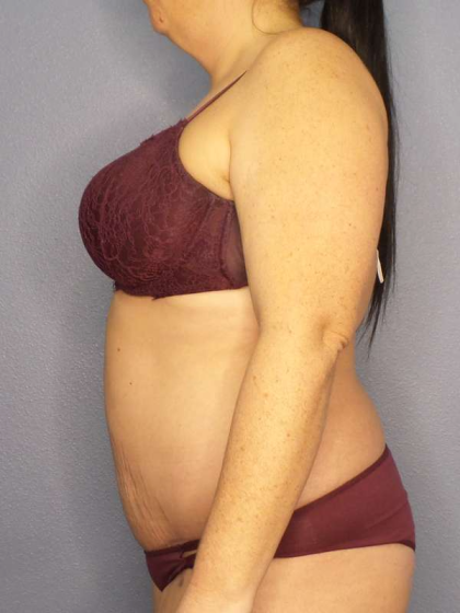 Abdominoplasty Before & After Patient #3572