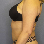 Liposuction Female Before & After Patient #7966