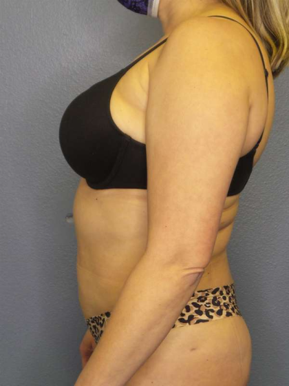 Liposuction Female Before & After Patient #7966