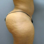 Brazilian Butt Lift Before & After Patient #4903