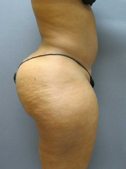 Brazilian Butt Lift Before & After Patient #4903