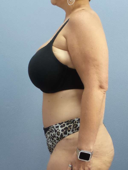 Abdominoplasty Before & After Patient #3786