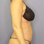 Liposuction Female Before & After Patient #8058