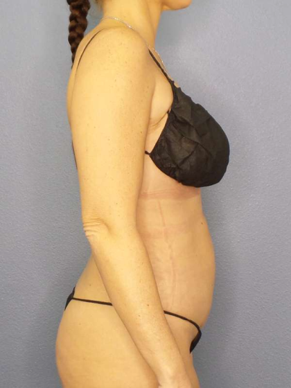 Liposuction Female Before & After Patient #8058