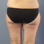 Liposuction Female Before & After Patient #7709