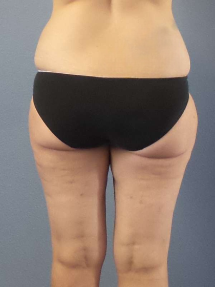 Liposuction Female Before & After Patient #7709