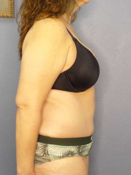 Abdominoplasty Before & After Patient #3188