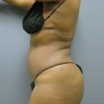 Liposuction Female Before & After Patient #7668