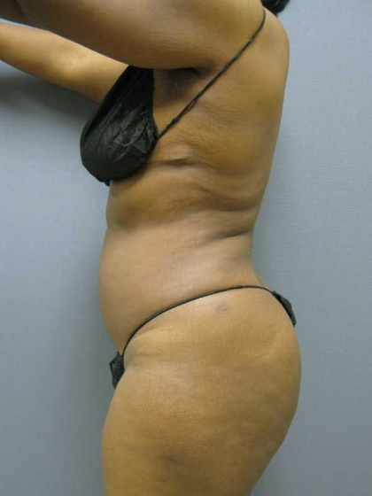 Liposuction Female Before & After Patient #7668