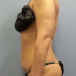 Abdominoplasty Before & After Patient #3775