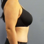 Abdominoplasty Before & After Patient #3550