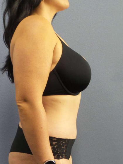 Abdominoplasty Before & After Patient #3550