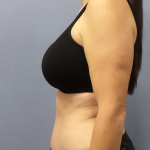 Abdominoplasty Before & After Patient #3471