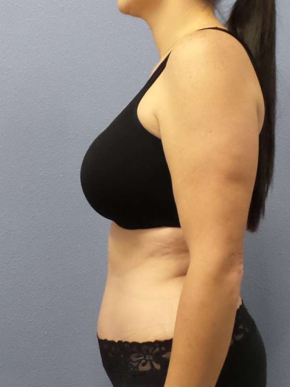 Abdominoplasty Before & After Patient #3471
