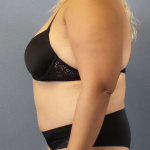 Abdominoplasty Before & After Patient #3437