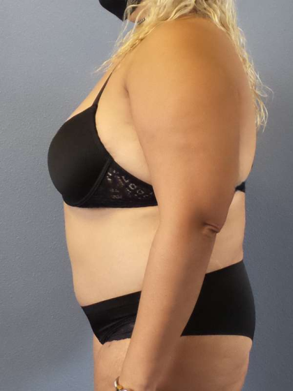Abdominoplasty Before & After Patient #3437