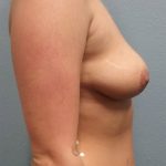 Breast Augmentation Before & After Patient #6469