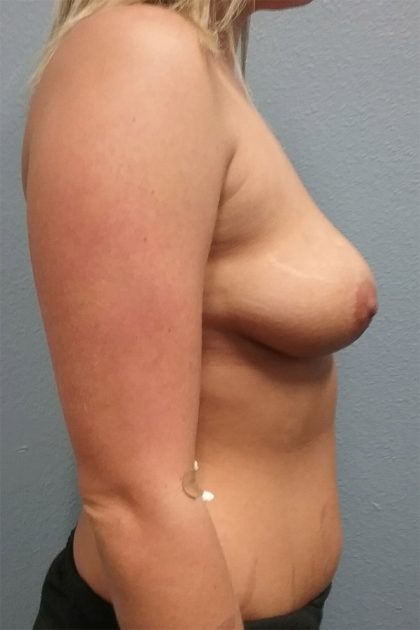 Breast Augmentation Before & After Patient #6469