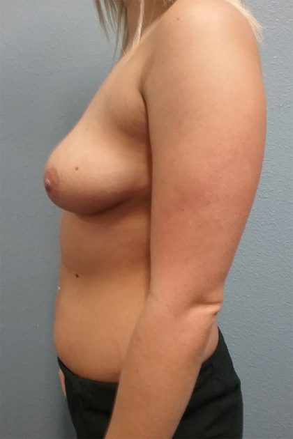 Breast Augmentation Before & After Patient #6469
