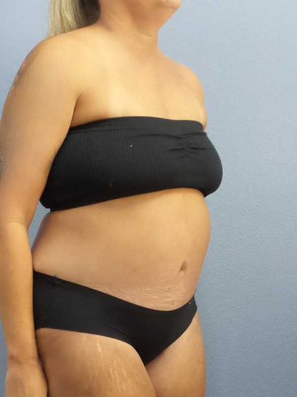 Abdominoplasty Before & After Patient #3594