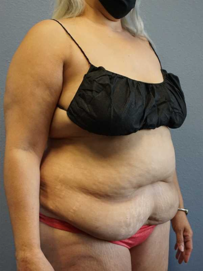 Abdominoplasty Before & After Patient #3437