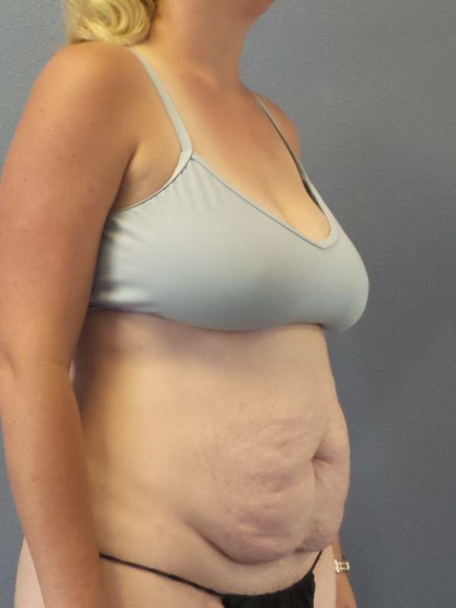 Abdominoplasty Before & After Patient #3409