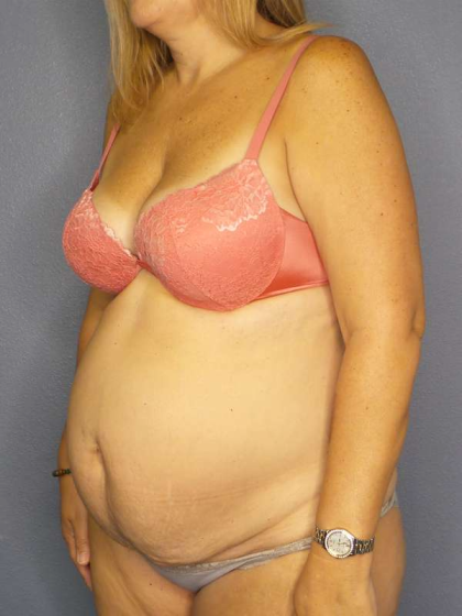 Abdominoplasty Before & After Patient #3350