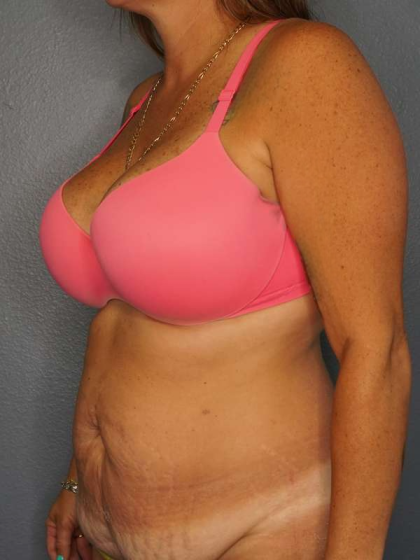 Abdominoplasty Before & After Patient #3272