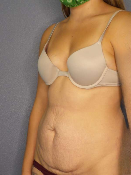 Abdominoplasty Before & After Patient #3236