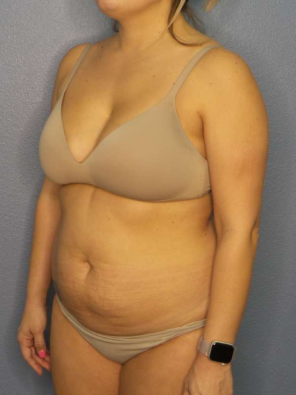 Abdominoplasty Before & After Patient #3225