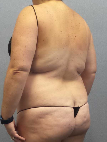 Liposuction Female Before & After Patient #11950
