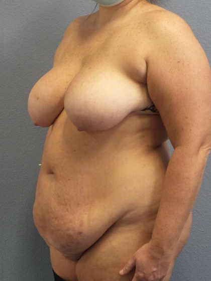 High BMI (Larger Patients) Surgery Before & After Patient #10431