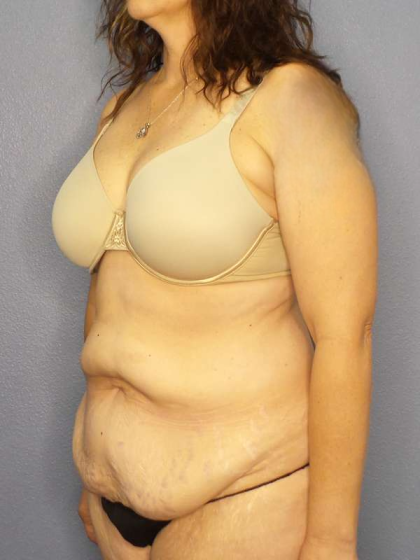 Abdominoplasty Before & After Patient #3188