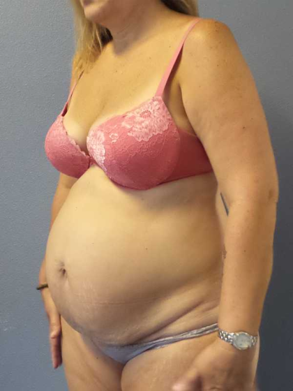 High BMI (Larger Patients) Surgery Before & After Patient #10329