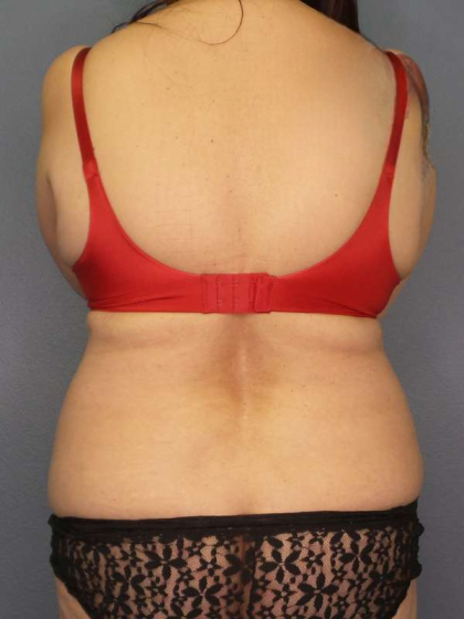 Liposuction Female Before & After Patient #7932