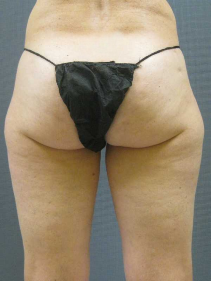 Liposuction Female Before & After Patient #7794