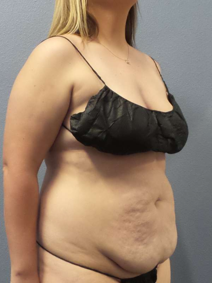 Abdominoplasty Before & After Patient #5197