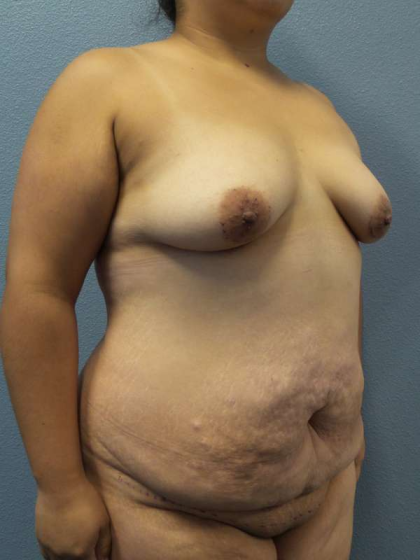 Abdominoplasty Before & After Patient #3735