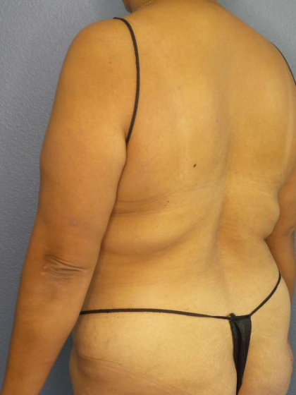 Abdominoplasty Before & After Patient #3638
