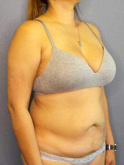 Abdominoplasty Before & After Patient #3583