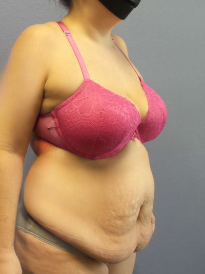Abdominoplasty Before & After Patient #3572