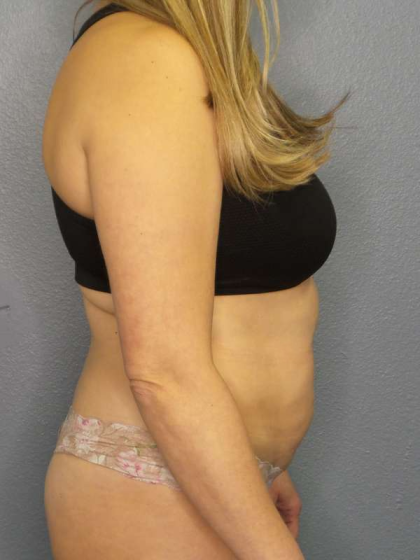 Liposuction Female Before & After Patient #7966