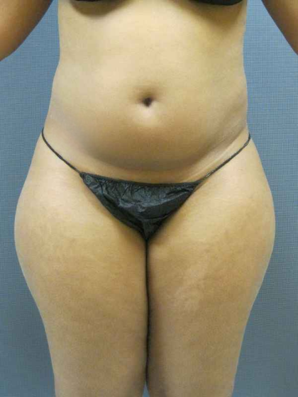 Brazilian Butt Lift Before & After Patient #4903