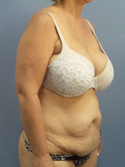 Abdominoplasty Before & After Patient #3786